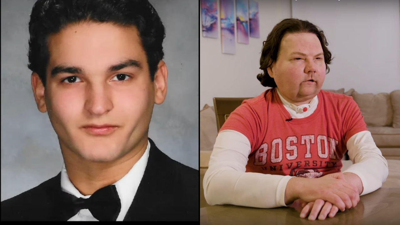 Joe pred nehodou a po operácii