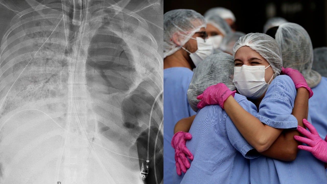 pľúca COVID-19, sestričky v objatí