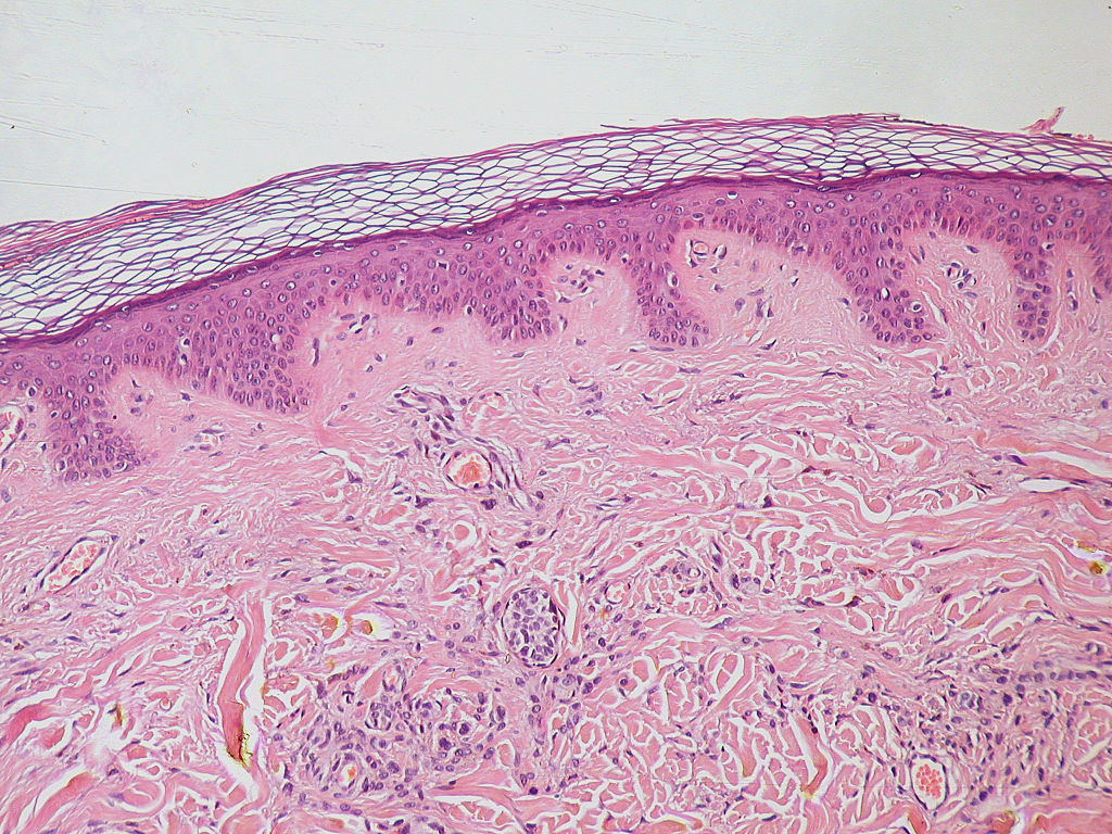 Normal_Epidermis_and_Dermis_with_Intradermal_Nevus_10x (1)