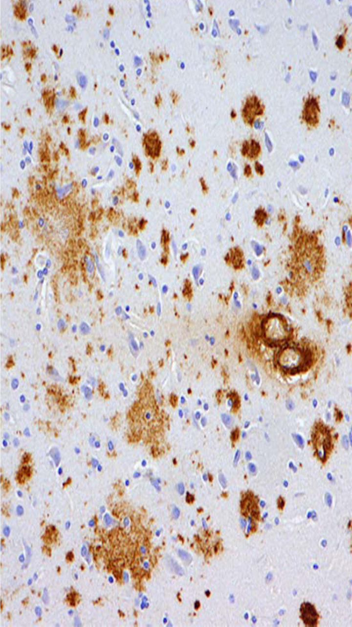 Krvná test odhaľujúci Alzheimera