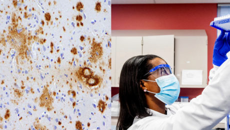 Krvý test Alzheimer