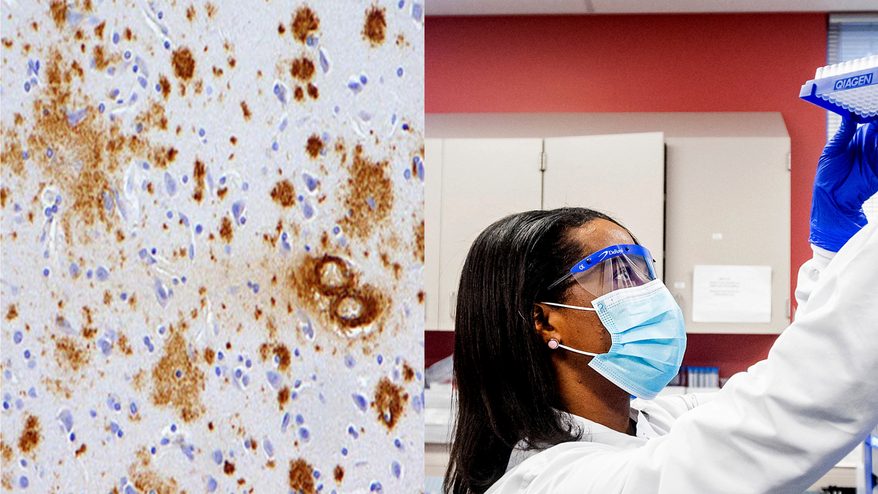 Krvý test Alzheimer