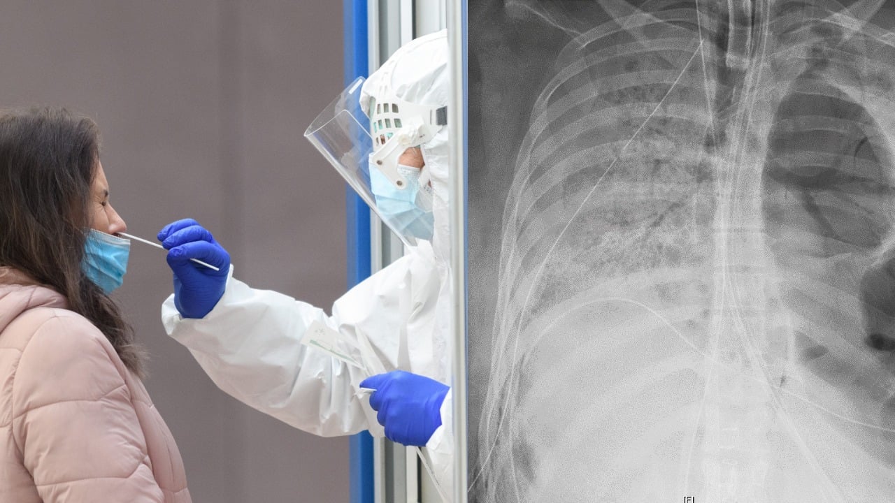 Na snímke z júna 2020  je röntgen hrude pacientky s infekčným ochorením COVID-19