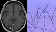 Migrény, paralýza tváre