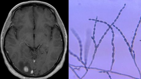Migrény, paralýza tváre
