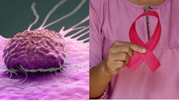 Vedci zistili, kedy sa rakovina prsníka šíri agresívnejšie. Teraz sa liečba môže zmeniť