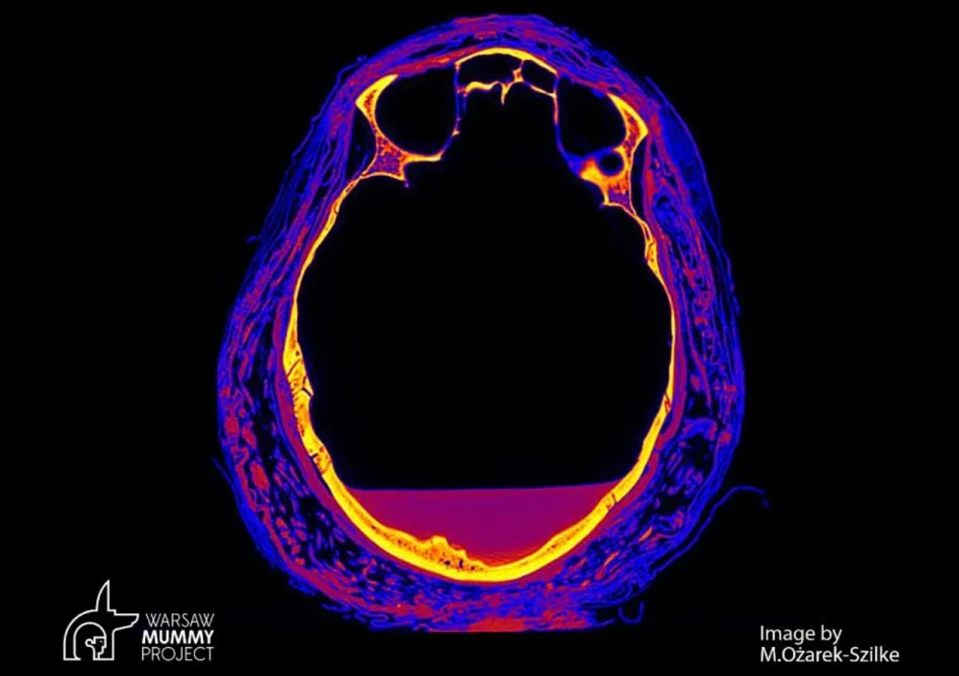 CT snímok starovekej tehotnej múmie