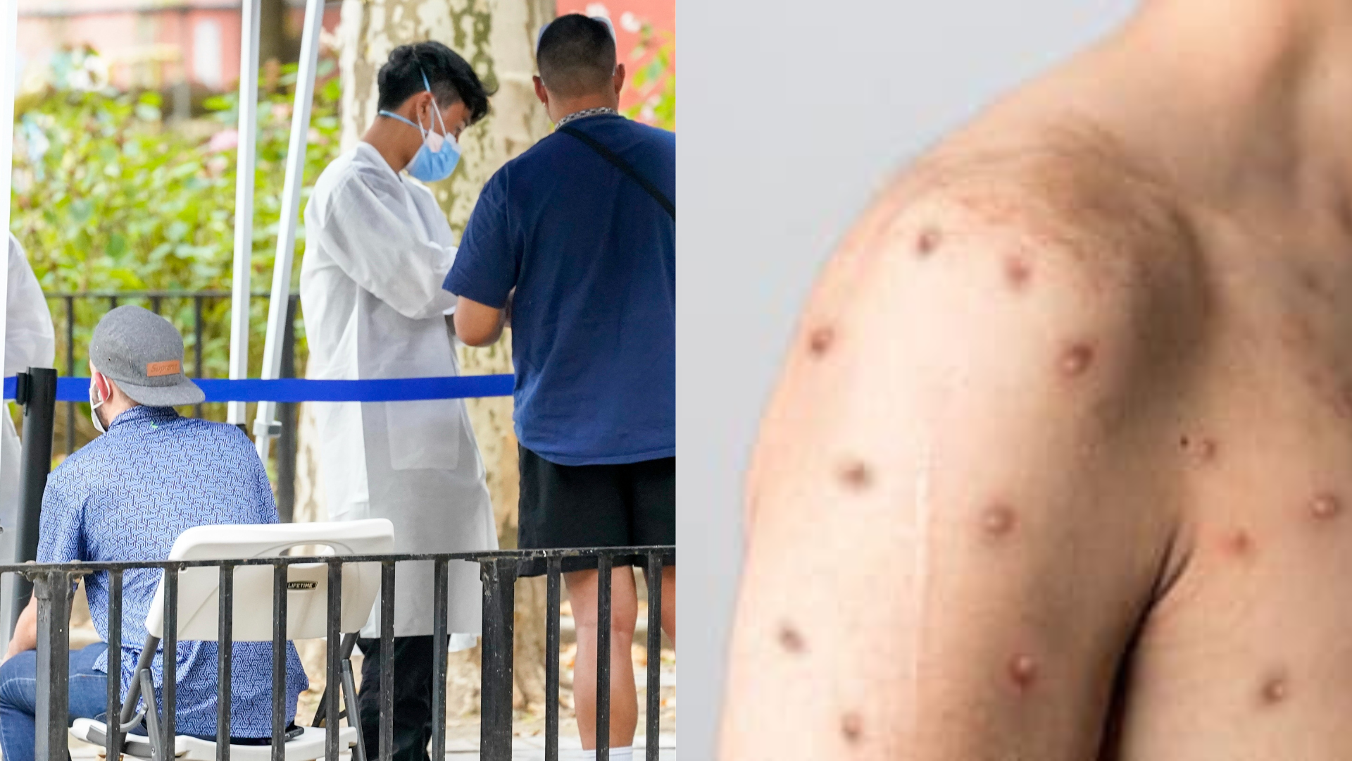 Prípady opičích kiahní