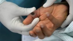 Lekár ukazuje vyrážku na ruke pacienta, ktorý sa lieči na ochorenie opičích kiahní v nemocnici v Lime v utorok 16. augusta 2022.