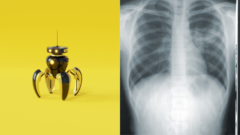Malý robot a snímka zápalu pľúc
