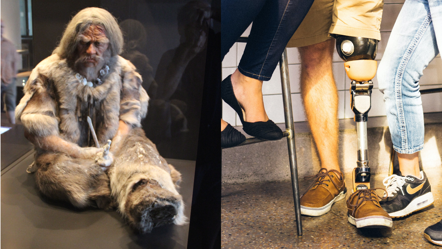 doba kamenná amputácia