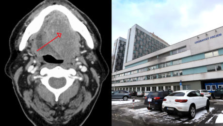 Rakovina úst, scan, rontgen, nemocnica v Banskej Bystrici
