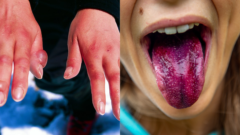 Opuchnuté prsty a sfarbený jazyk