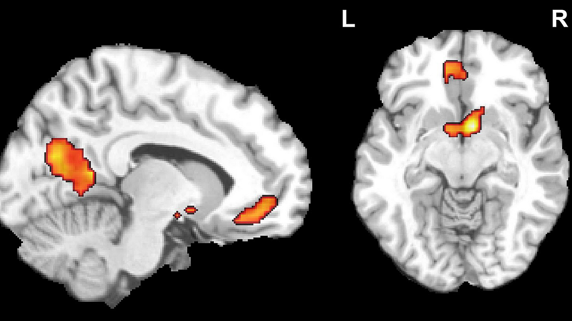 snímka mozgu