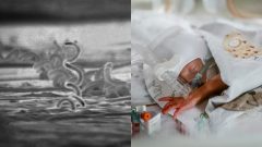 Baktéria pohlavne prenosnej choroby Syfilis a istý novorodenec