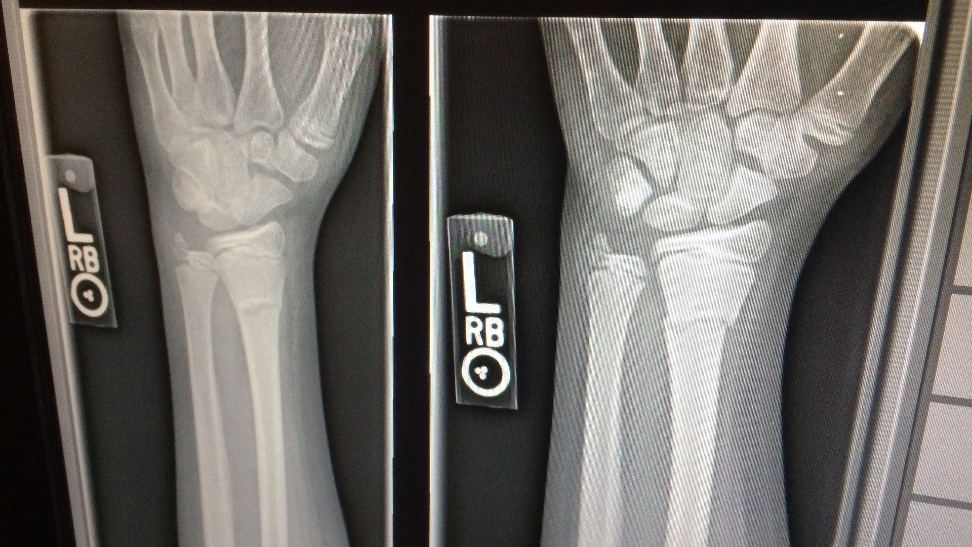 rongten zlomenina ruka úraz