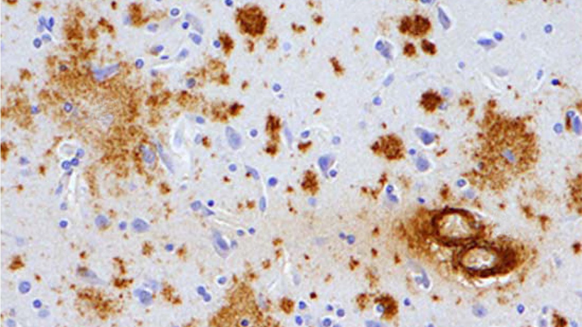 test na Alzheimerovu chorobu