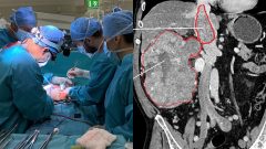 nemocnica banská bystrica slovensko nádor operácia rugby