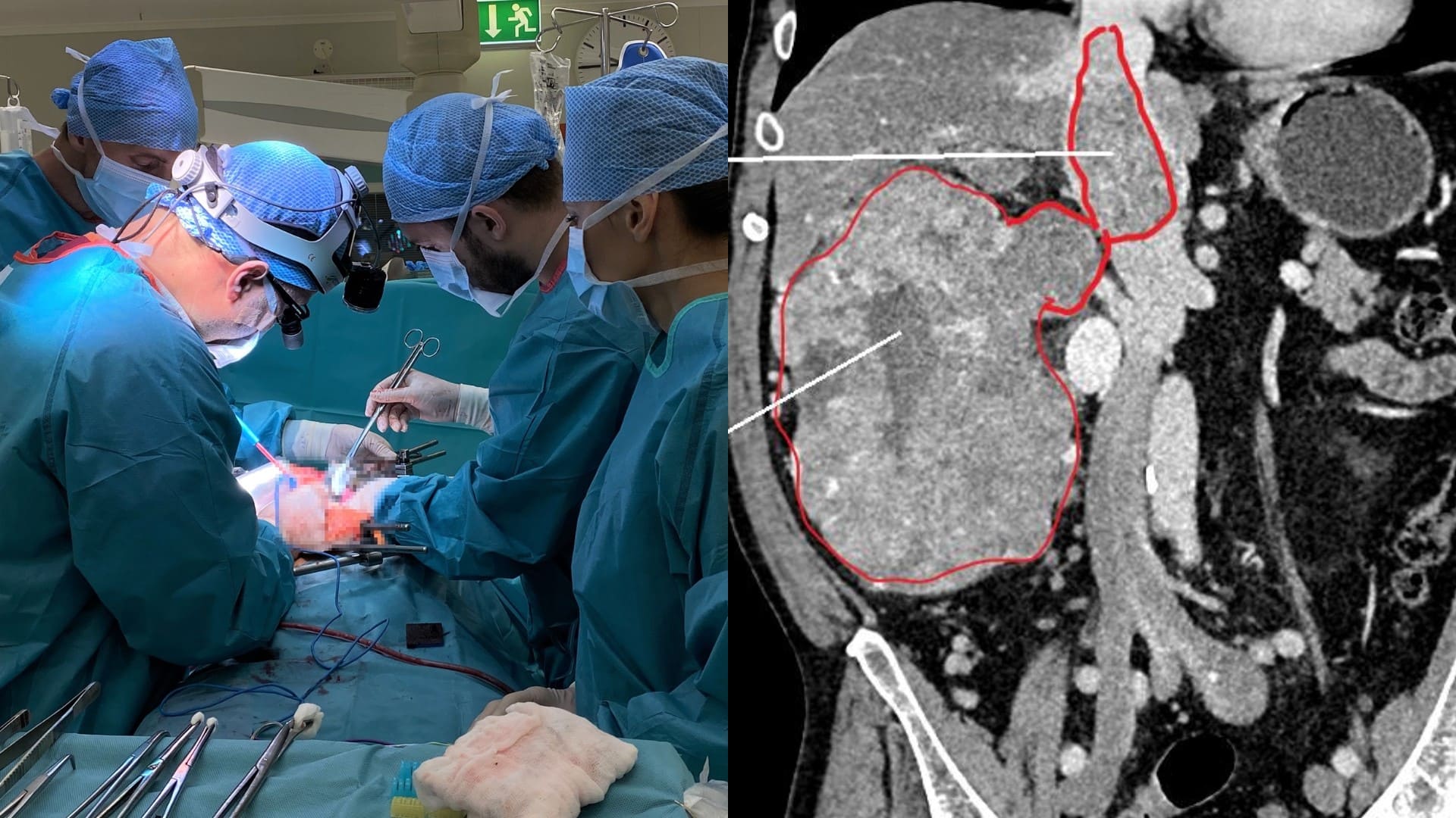 nemocnica banská bystrica slovensko nádor operácia rugby