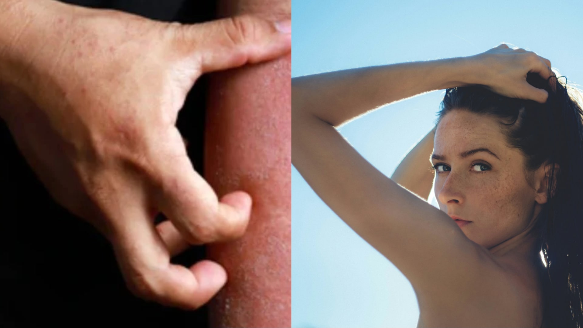 ekzém, žena so zdvihnutými rukami sa díva do kamery