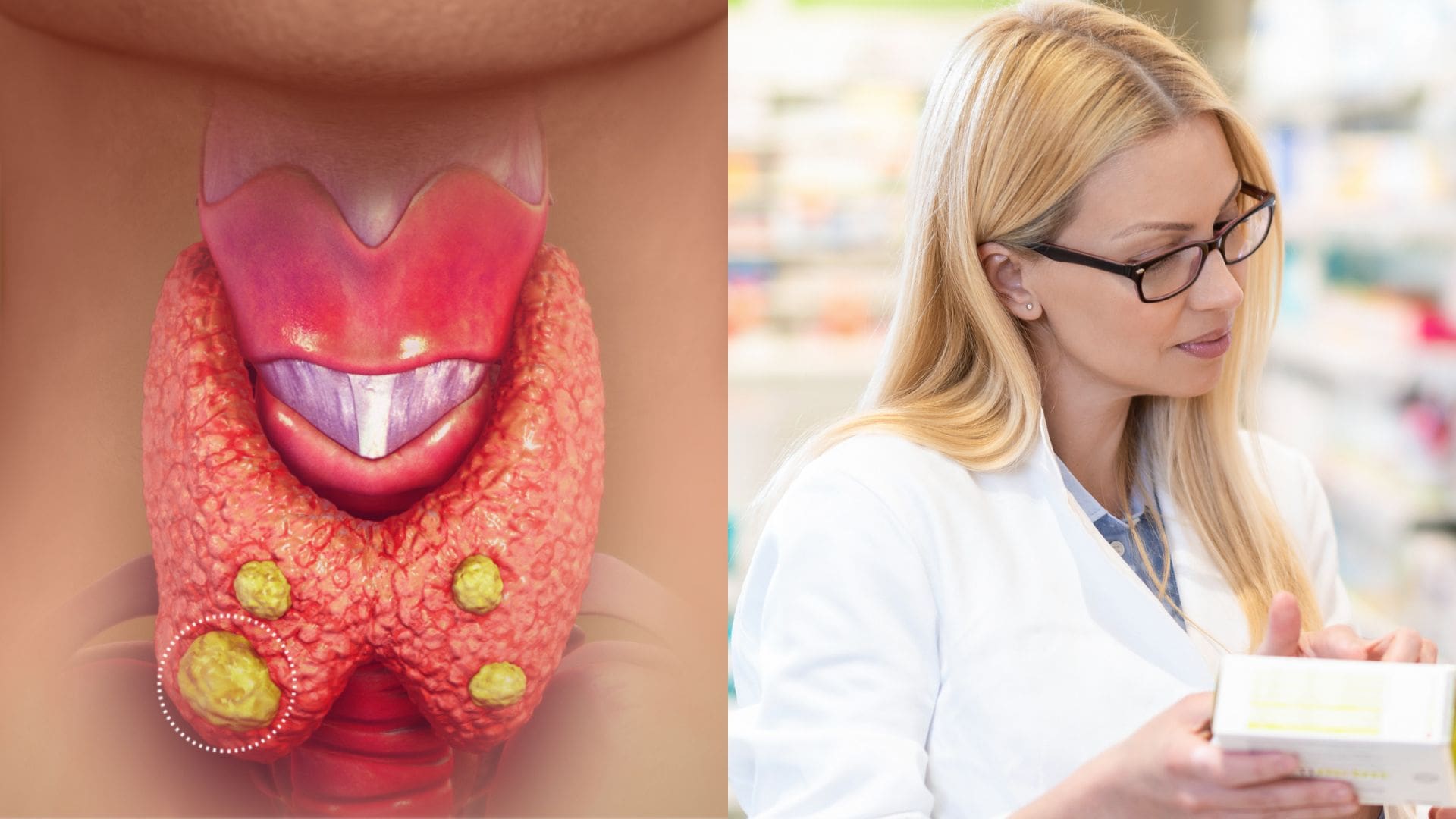 Cinacalcet Reddy, hyperparatyreóza, lieky