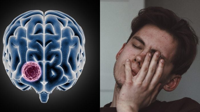 Mozog bolesť necíti, no hlava ti ide „prasknúť“. Neurologička vysvetľuje vedu za explozívnou bolesťou