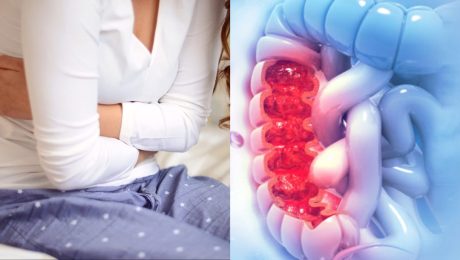 bolesť brucha, črevá