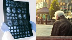 na snimke je bioenergeticky vek, alzheimer