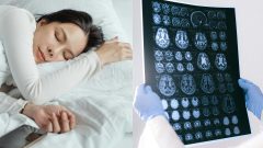 na snimke je alzheimer, lieky na spanie