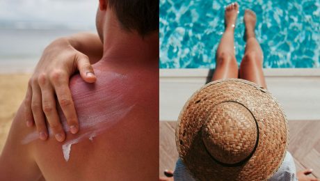 čo robiť pri spálení