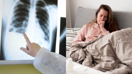 pľúca, rakovina pľúc