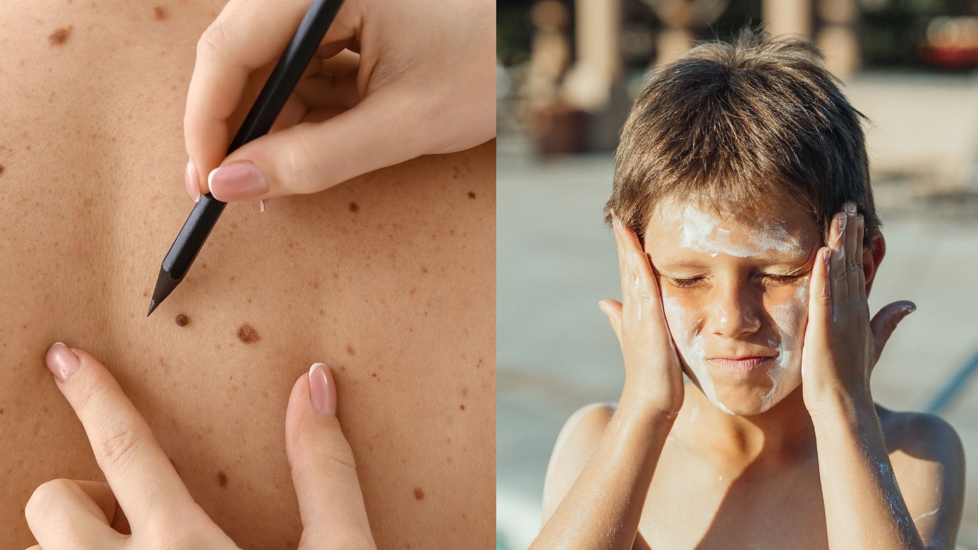 Kožné nádory a ako sa pred nimi účinne chrániť