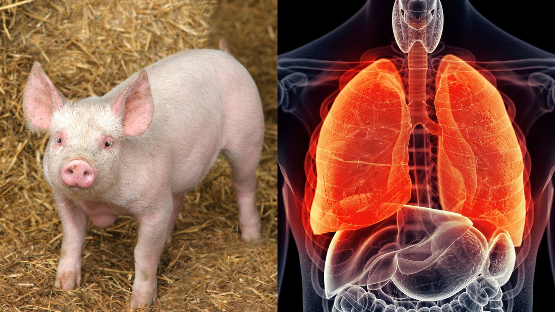 Prvá transplantácia prasacích pľúc do ľudského tela