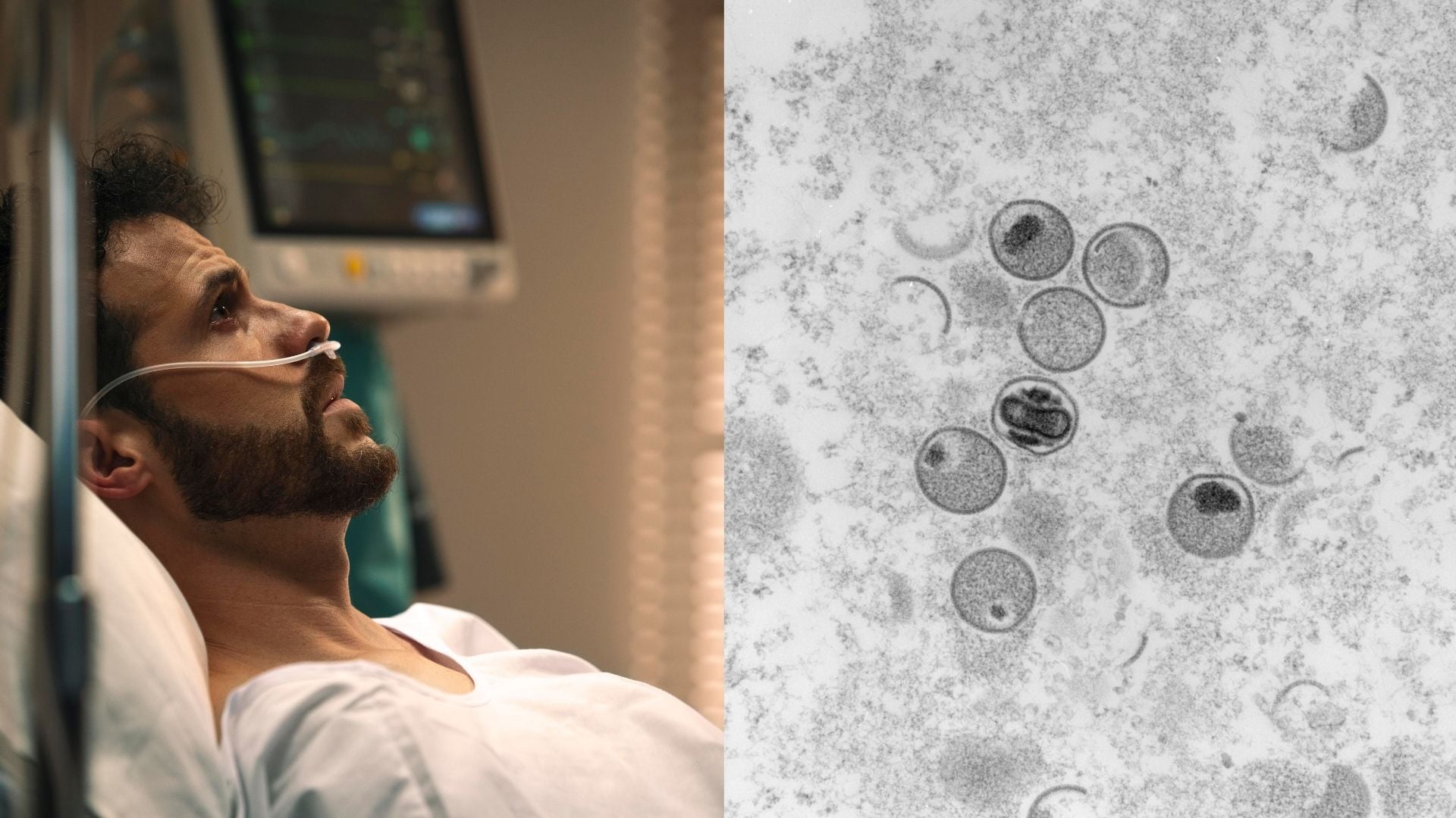 opičie kiahne, mpox