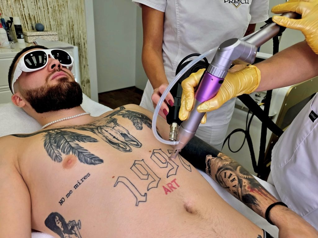 odstránenie tetovania