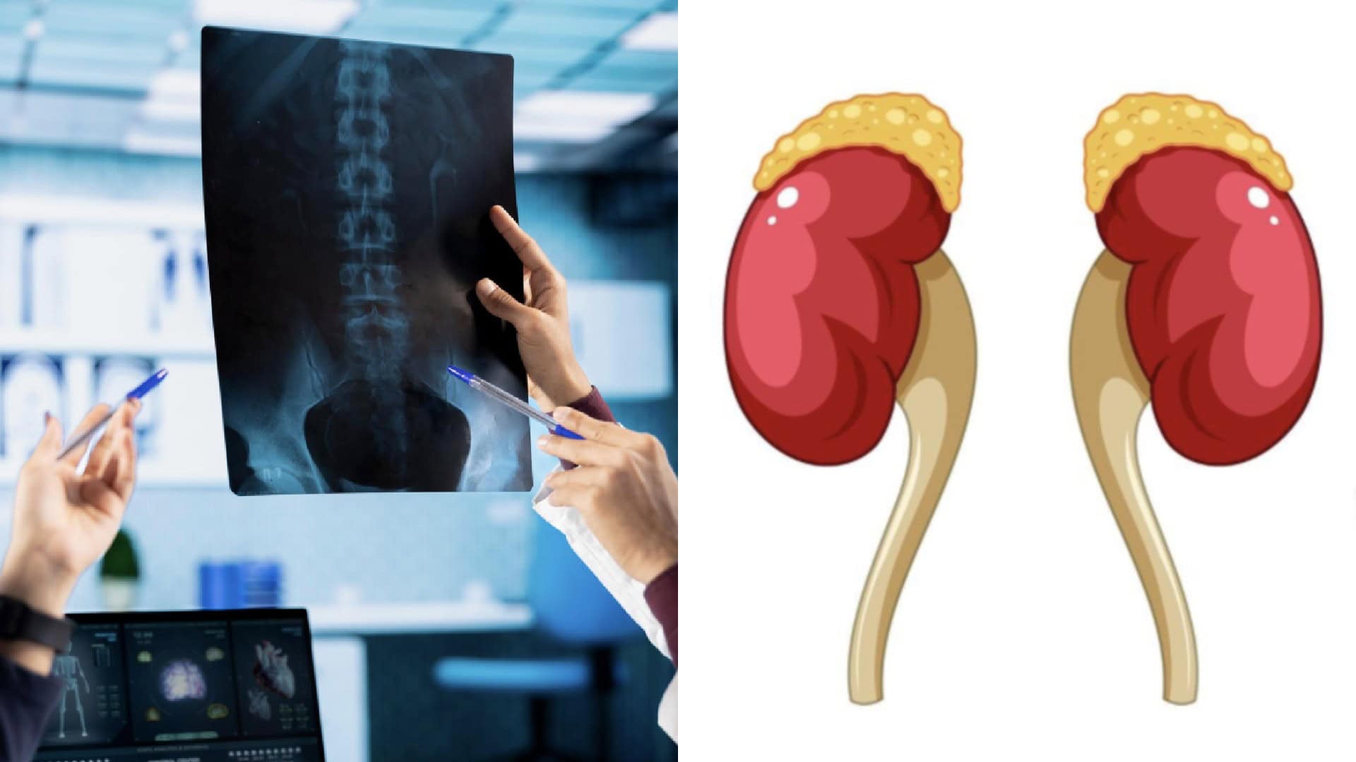 röntgen, nadobličky