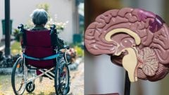 Alzheimer