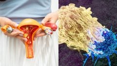 Onkologička varuje Slovenky pred rakovinou vaječníkov: Spočiatku ju necítia. Banálne príznaky nesmieš ignorovať