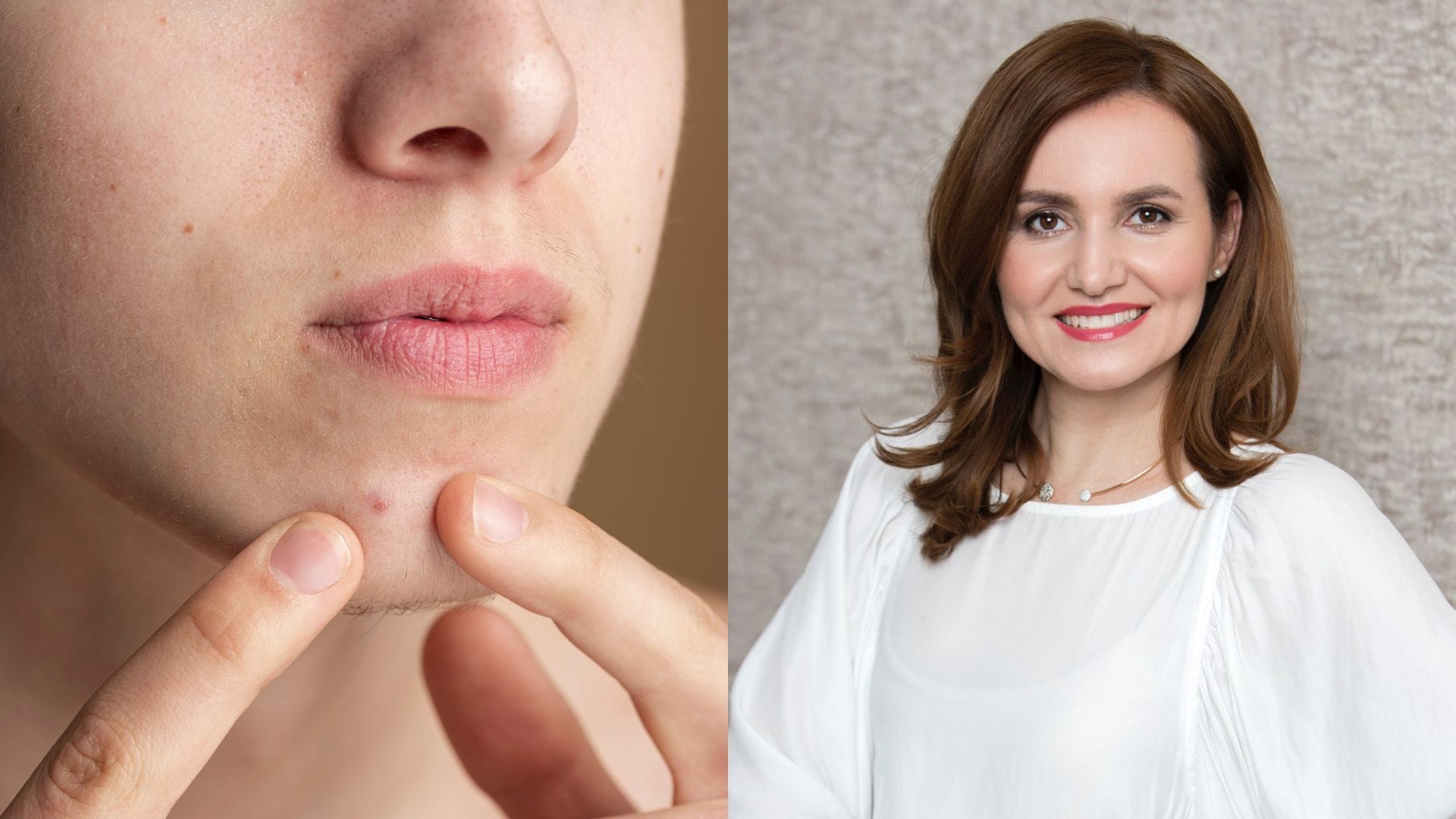 Životný stres Slovákom ničí pleť: Odborníčka prezradila, prečo akné trápi aj dospelých