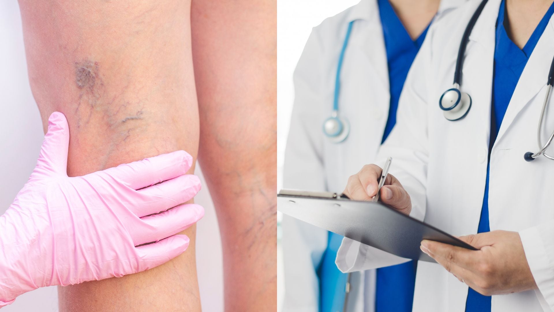 krčove žily, doktor