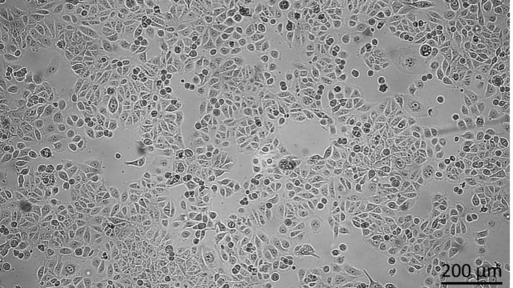 Nádorové bunky rakoviny prsníka pod mikroskopom