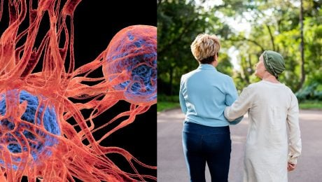 Rakovina hrubého čreva