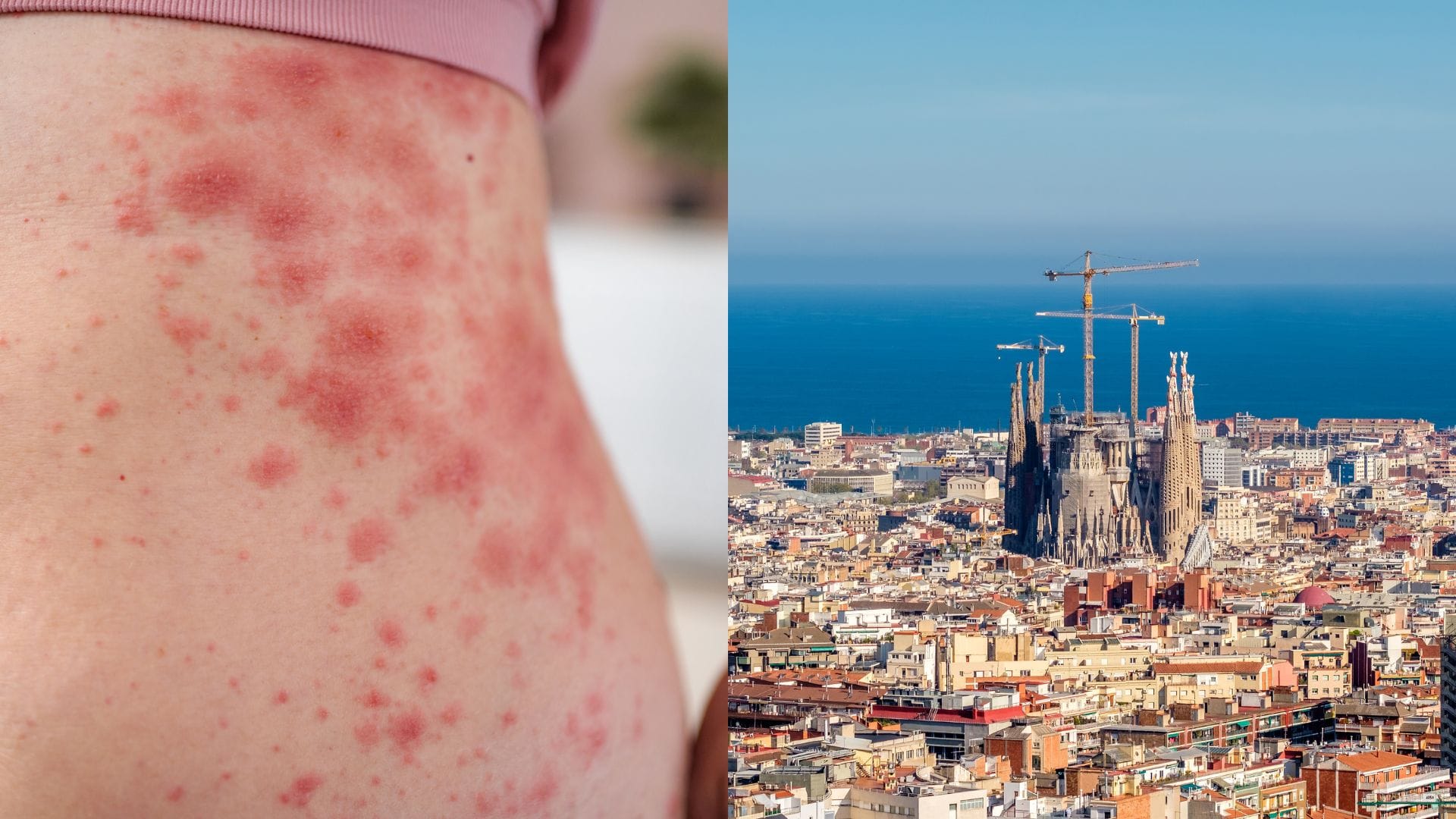 V saunách a turistických mestách sa objavila nezvyčajná baktéria. Symptómy pripomínajú mpox