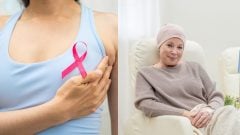 Prelom v liečbe rakoviny prsníka: Tisíce žien by sa mohli vyhnúť chemoterapii