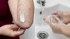 V Európe vyčíňa vzácna „dažďová hniloba“. Ochorenie známe u zvierat napáda ľuďom tvár a intímne partie