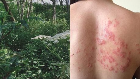 Na Slovensku sa šíri nebezpečný gigant z Kaukazu: Pozor na rastlinu, ktorej dotyk spôsobuje bolestivé pľuzgiere
