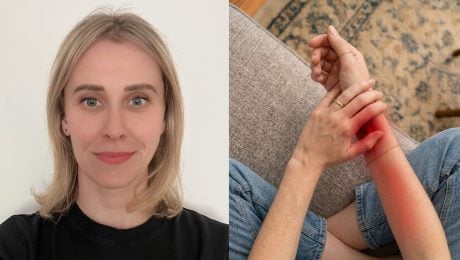 mravčenie v končatinách