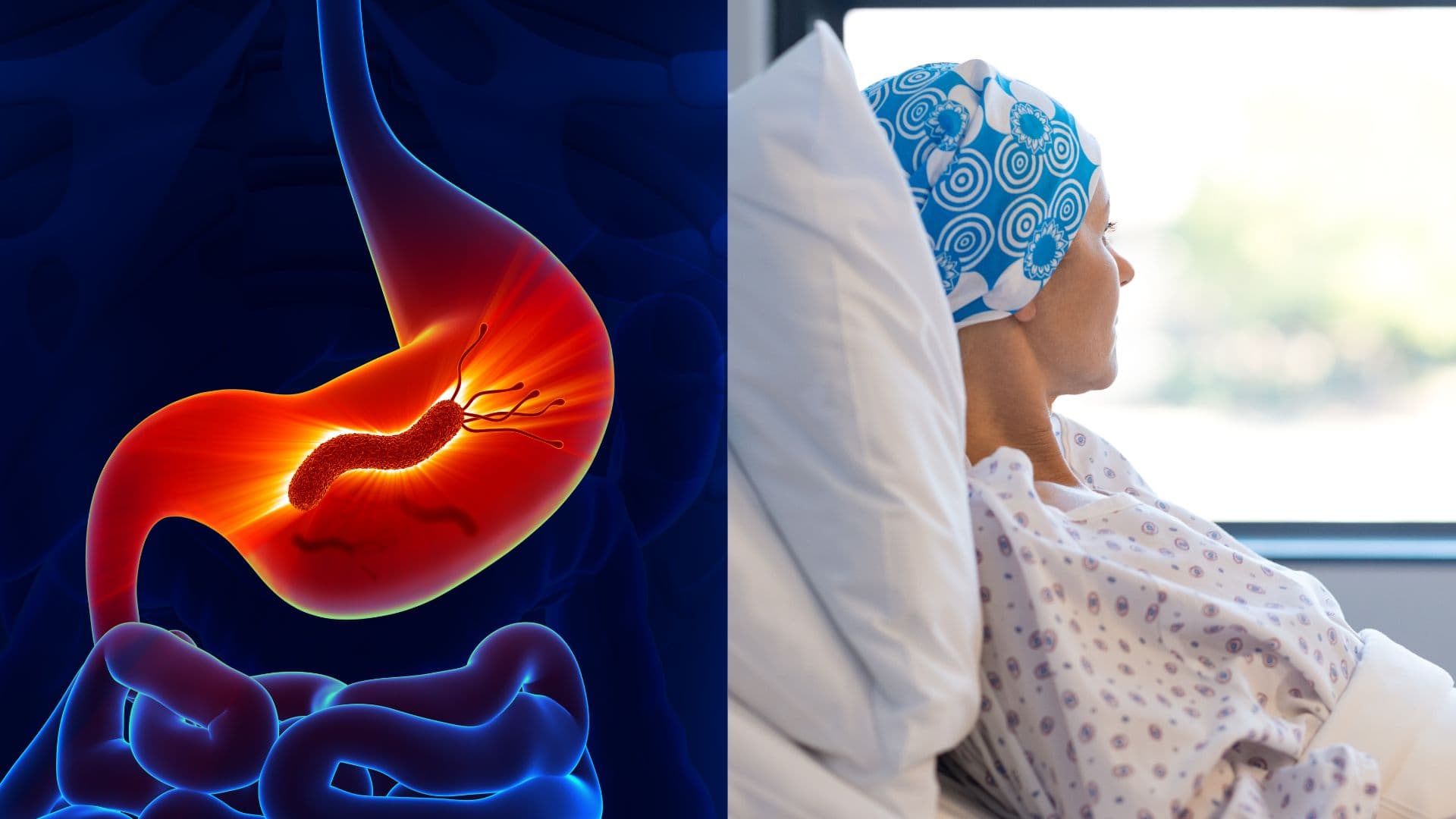 Helicobacter pylori môže súvisieť s rakovinou hrubého čreva
